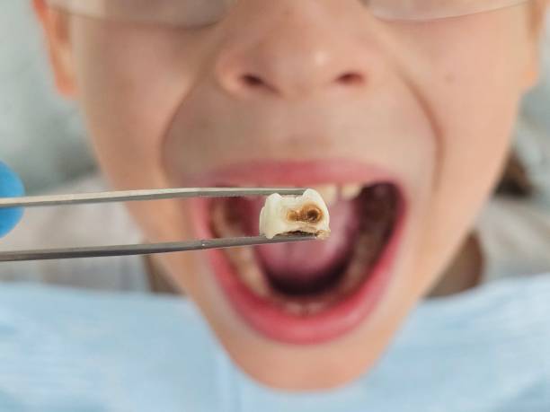 Best Emergency Treatment for Toothache in Des Allemands, LA